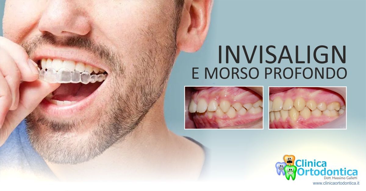 Invisalign e morso profondo  Blog Clinica Ortodontica Dott. Galletti