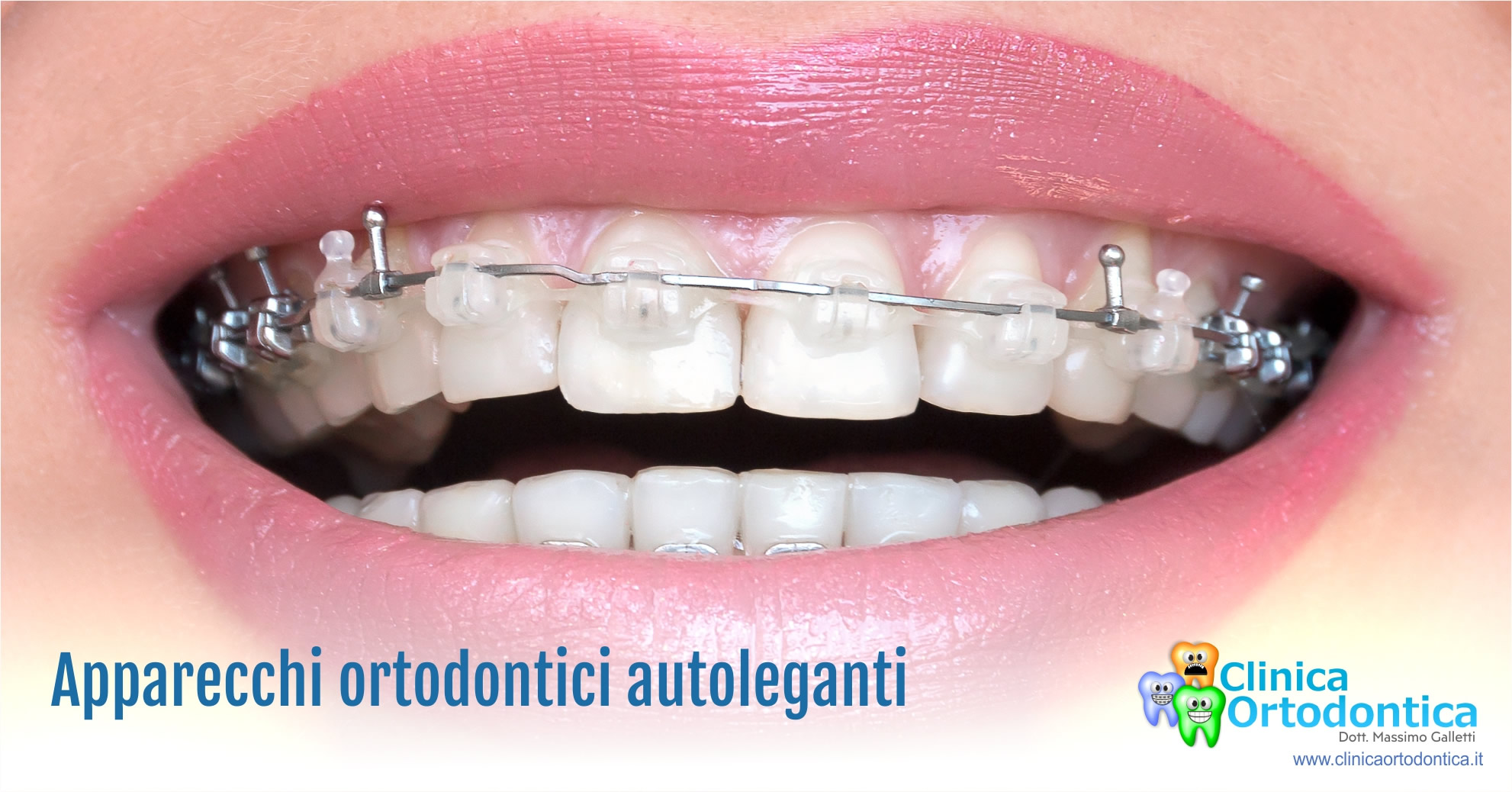 Apparecchi ortodontici autoleganti, Clinica Ortodontica del Dott. Massimo  Galletti