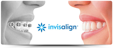 Apparecchi ortodontici invisibili Invisalign