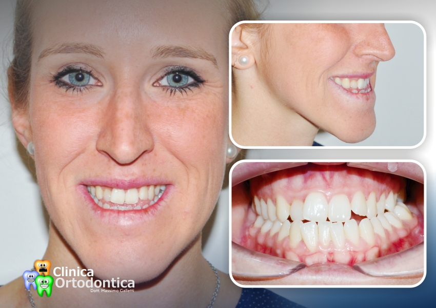 Correzione di una classe 3 dentoscheletrica con trattamento ortodontico-chirurgico Surgery First - prima del trattamento
