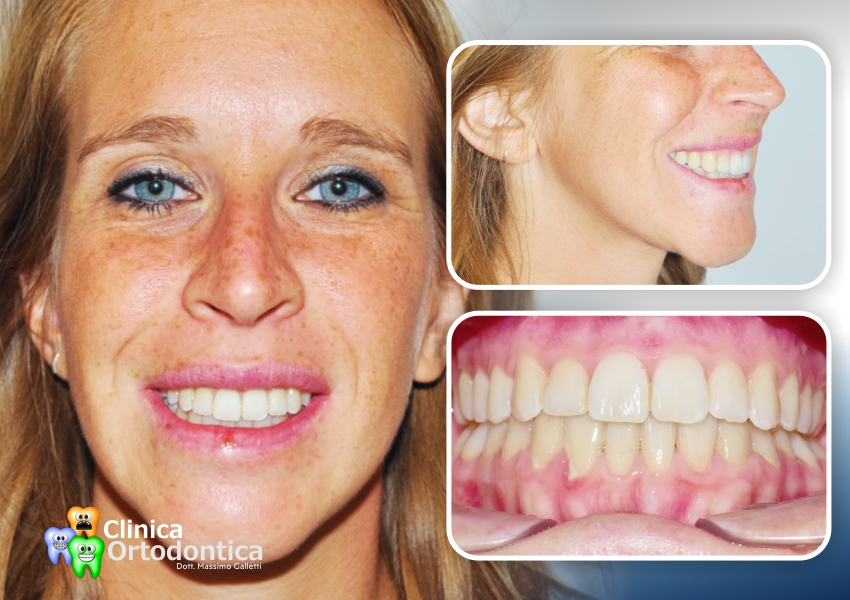 Correzione di una classe 3 dentoscheletrica con trattamento ortodontico-chirurgico Surgery First - dopo il trattamento