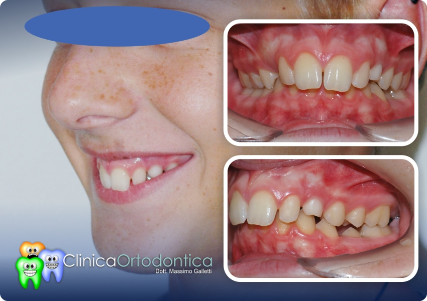 Trattamento ortodontico per classe 2 con mandibola retroposta - prima del trattamento
