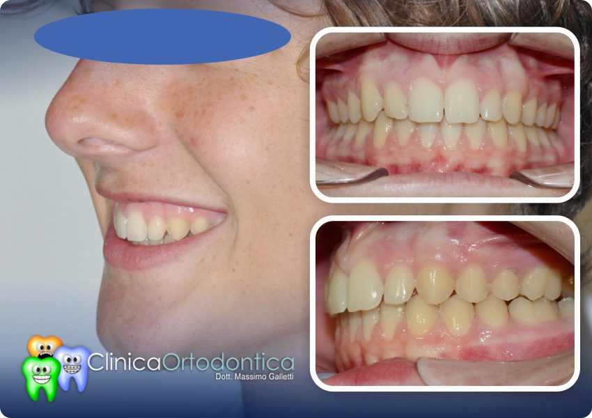 Trattamento ortodontico per classe 2 con mandibola retroposta - dopo il trattamento