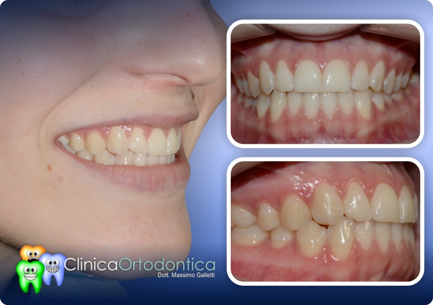 Trattamento ortodontico linguale - dopo il trattamento