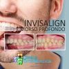 Invisalign e morso profondo