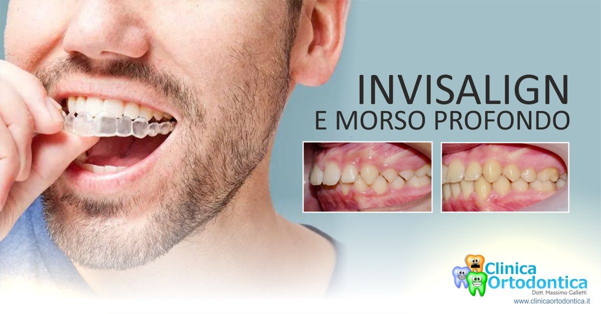 Invisalign e morso profondo, Blog clinica ortodontica Palermo