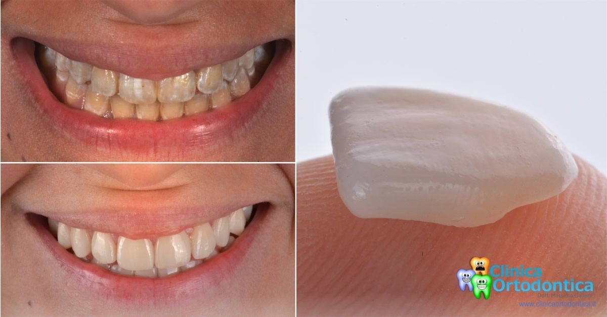 Le faccette dentali, Blog clinica ortodontica Palermo