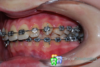 Durante trattamento ortodontico