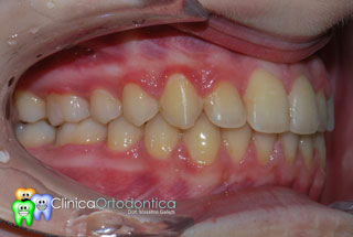 Dopo il trattamento ortodontico