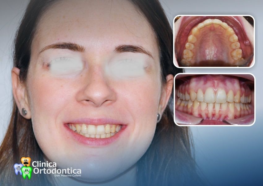 Trattamento ortodontico con allineatori trasparenti Invisalign - dopo il trattamento