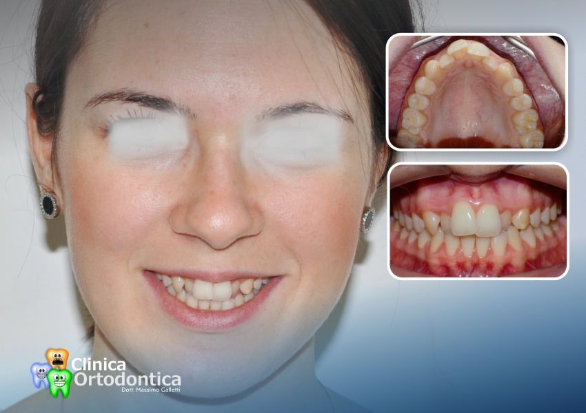 Trattamento ortodontico con allineatori trasparenti Invisalign - prima del trattamento