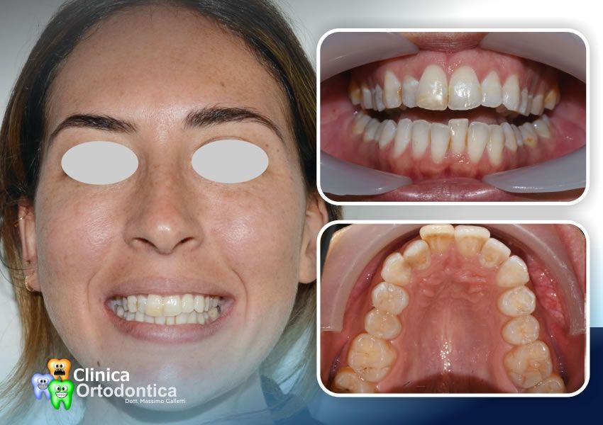 Paziente adulta trattata con allineatori trasparenti Invisalign - prima del trattamento