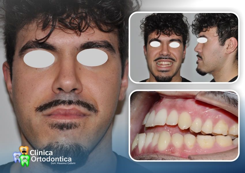 Severa malocclusione dento scheletrica caratterizzata da viso lungo - prima del trattamento
