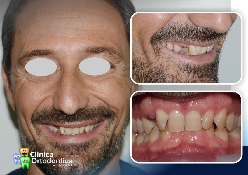 Paziente adulto trattato con allineatori trasparenti Invisalign - prima del trattamento