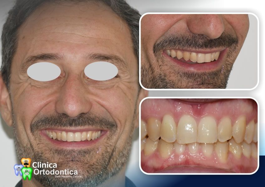 Paziente adulto trattato con allineatori trasparenti Invisalign - dopo il trattamento