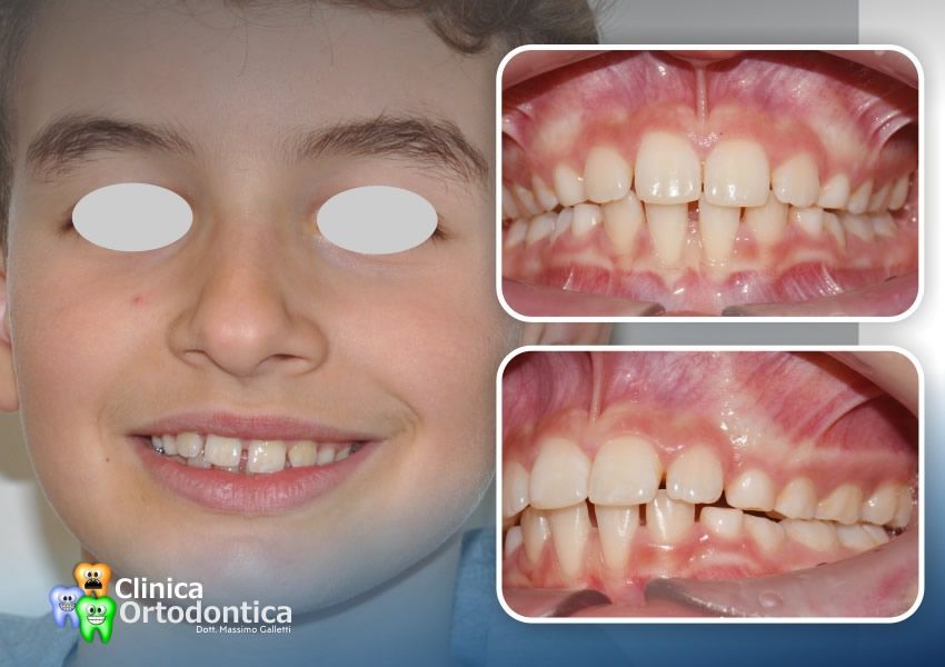 Retroposizione mandibolare e disfunzione della deglutizione con presenza di severa malocclusione di classe 2 - dopo il trattamento