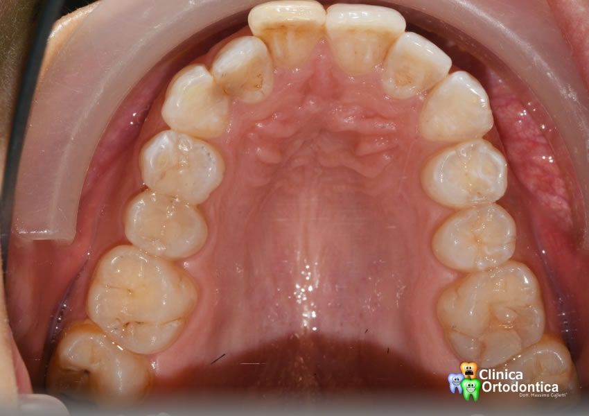 Prima del trattamento ortodontico