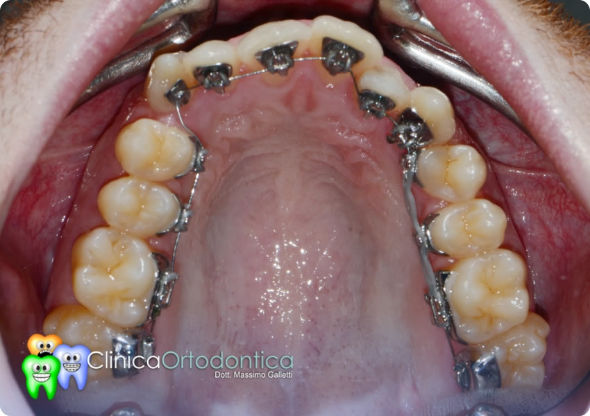 Durante trattamento ortodontico