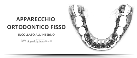 Apparecchio ortodontico linguale invisibile a Palermo