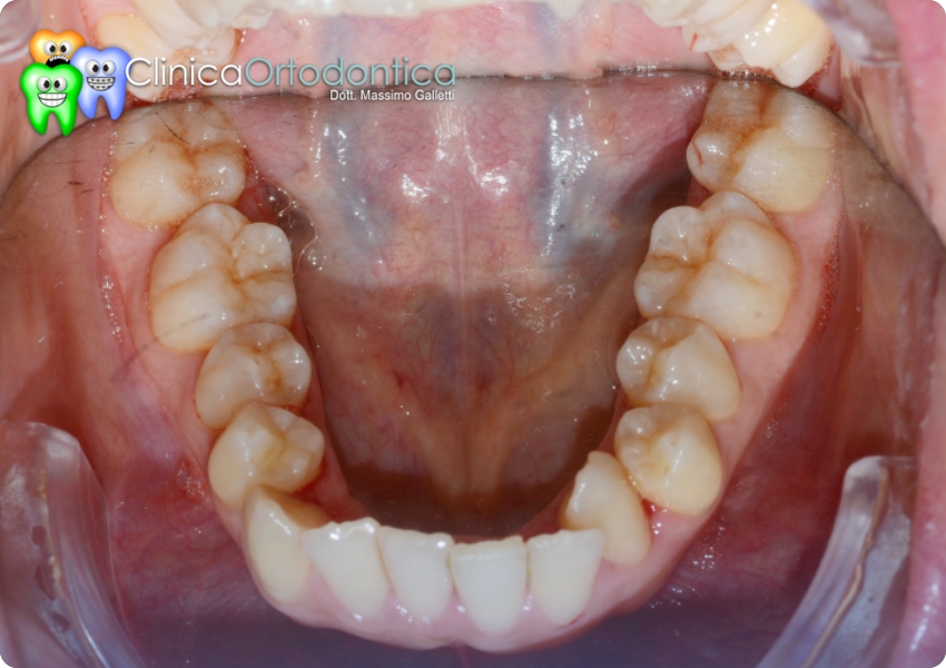 Prima del trattamento ortodontico