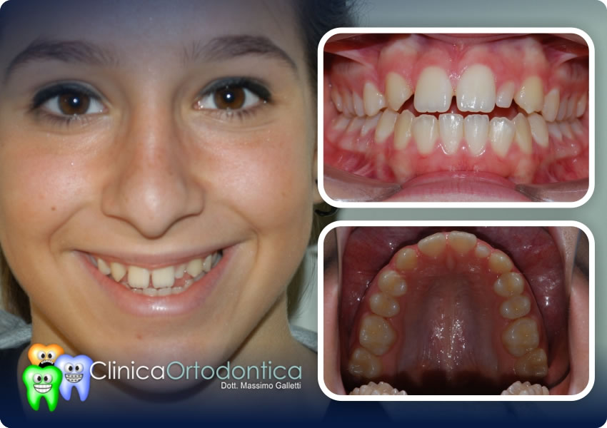 Agenesia 12, 22   conoide  e cl 3 dentale - prima del trattamento