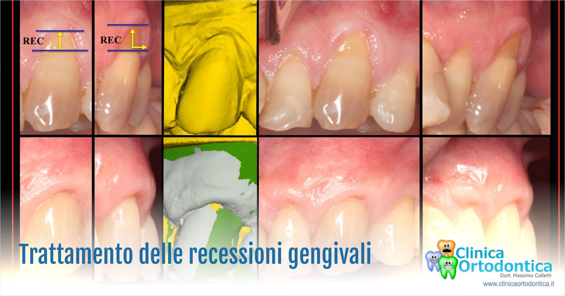 Trattamento delle recessioni gengivali Palermo