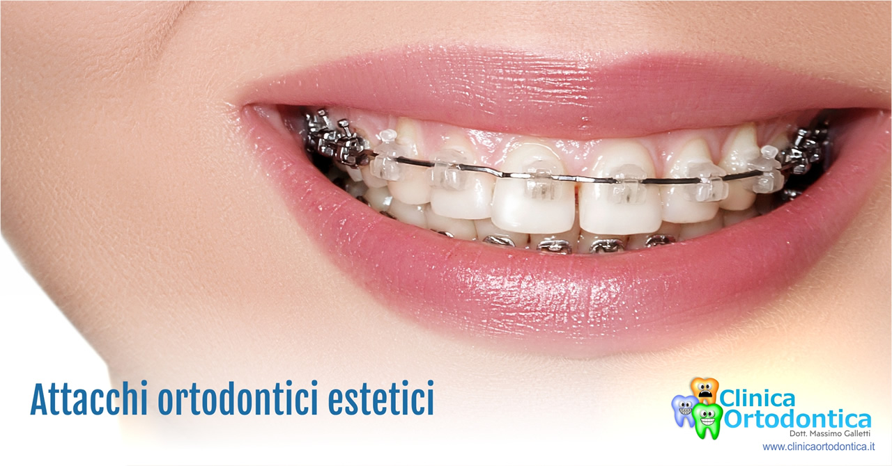 Attacchi ortodontici estetici