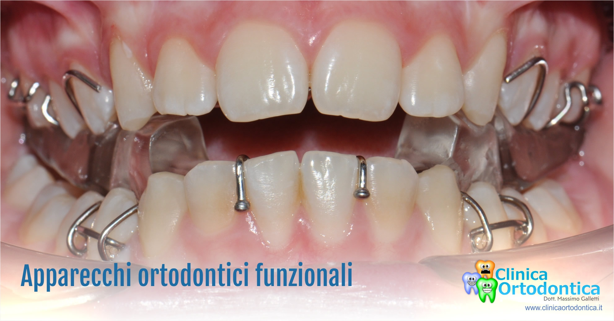 Apparecchi ortodontici funzionali