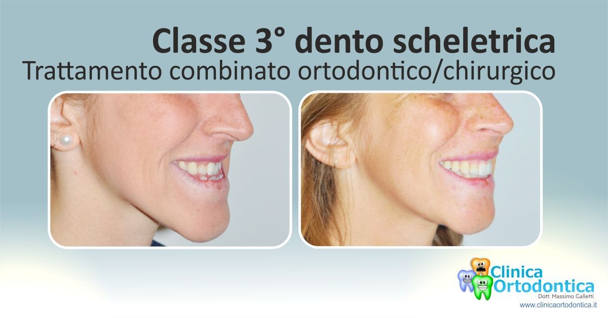 Classe 3° dento scheletrica, Blog clinica ortodontica Palermo