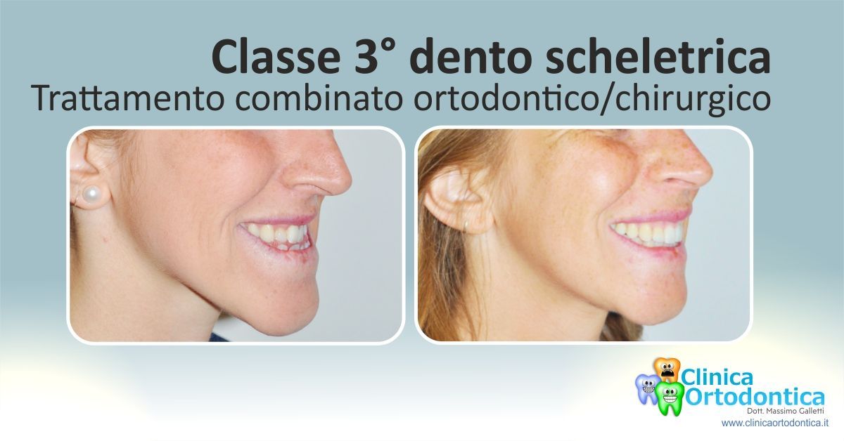 Classe 3 dento scheletrica, Blog clinica ortodontica Palermo