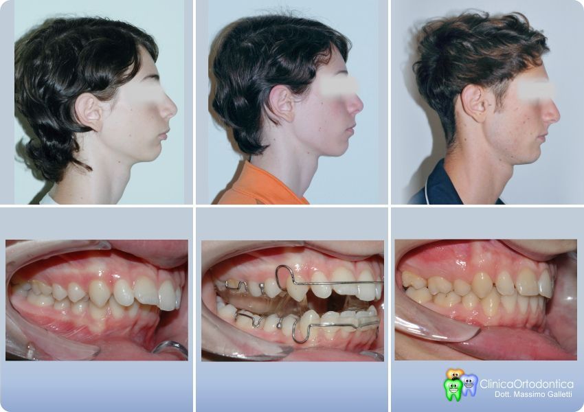 Dopo il trattamento ortodontico