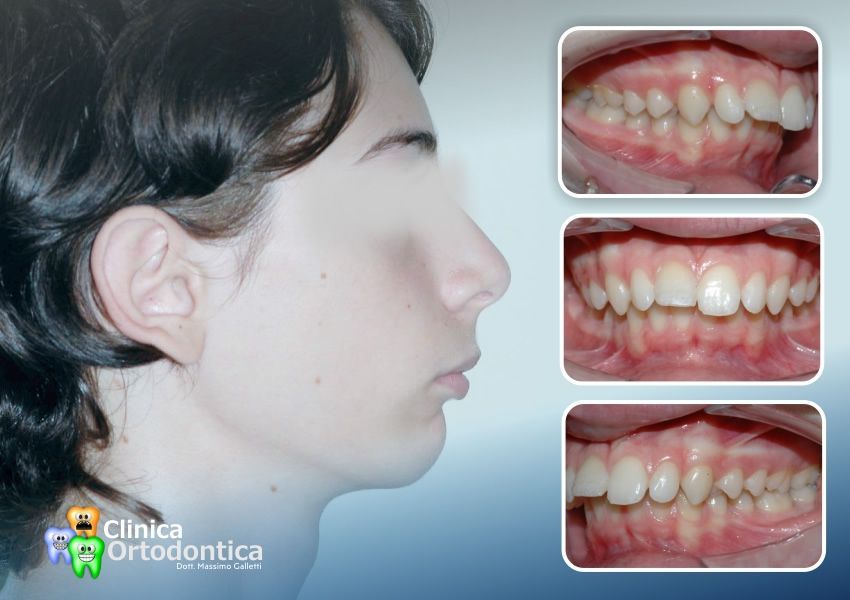 Trattamento ortopedico per mandibola retroposta - prima del trattamento