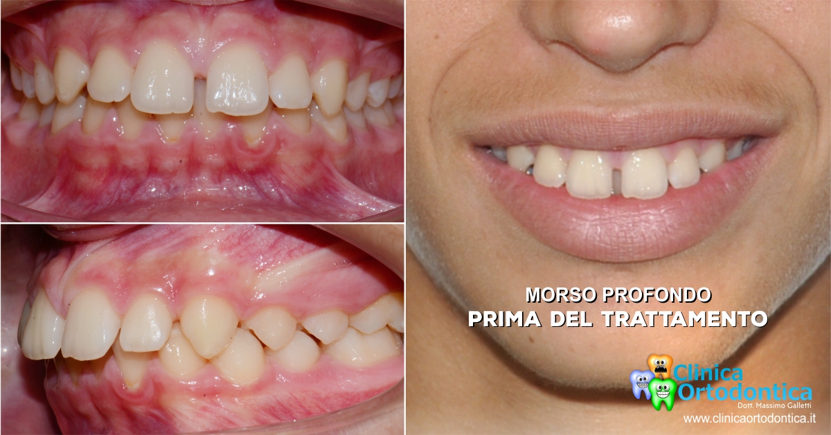 Morso profondo trattato con ortodonzia invisibile Invisalign Palermo